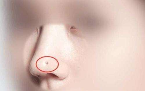 痣相,鼻子痣