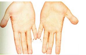 小拇指短代表什么?