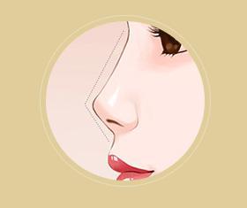 悬胆鼻和蒜头鼻的区别,两种鼻子命真的很好? 悬胆鼻和蒜头鼻的区别,两种鼻子命真的很好?